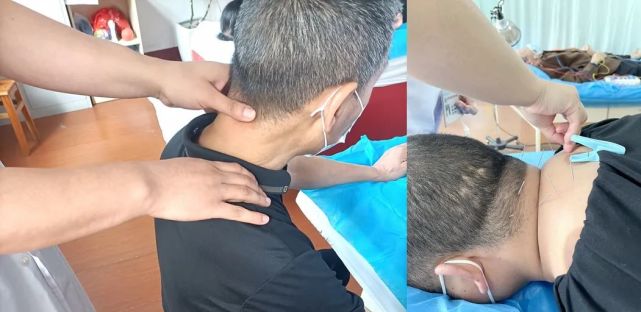 中医如何治疗颈椎病方法来了