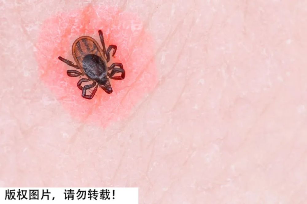 被咬后如何处理?_腾讯新闻