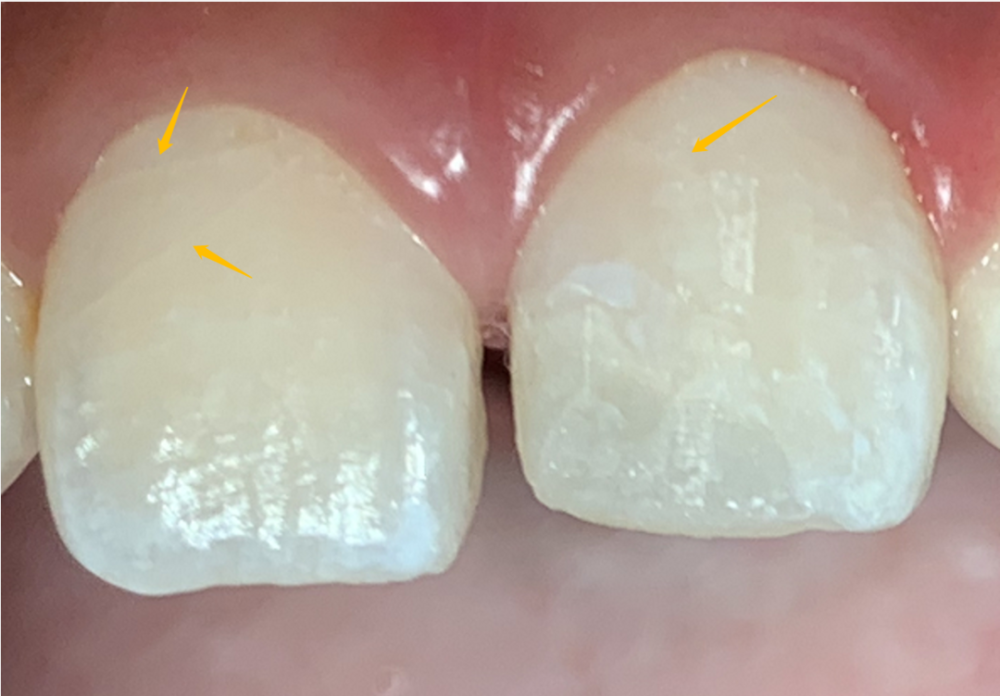 这些裂纹在x光片上能清晰得看到,说明相对比较深,也很容易在日后的
