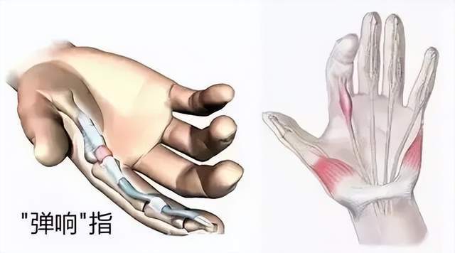手指腱鞘炎位置图片图片