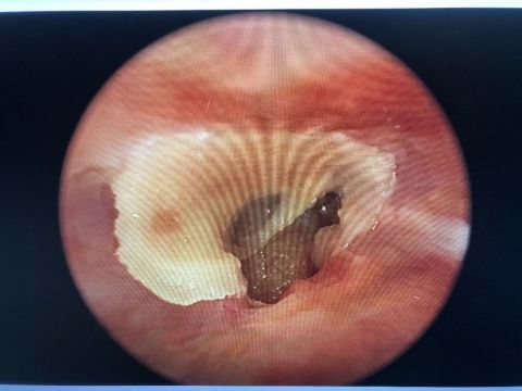 外耳道深处有白色固体,已经与外耳道皮肤紧紧黏附,左耳鼓膜已经穿孔