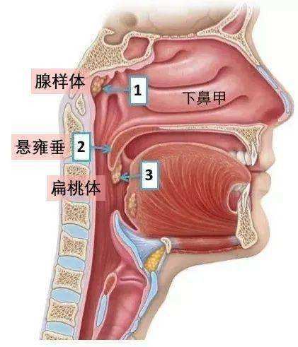 悬雍垂畸形图片