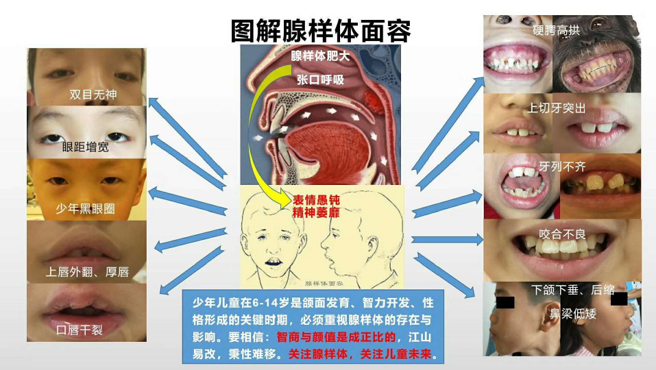 孩子呆呆傻傻腭骨高拱同时伴有口呼吸