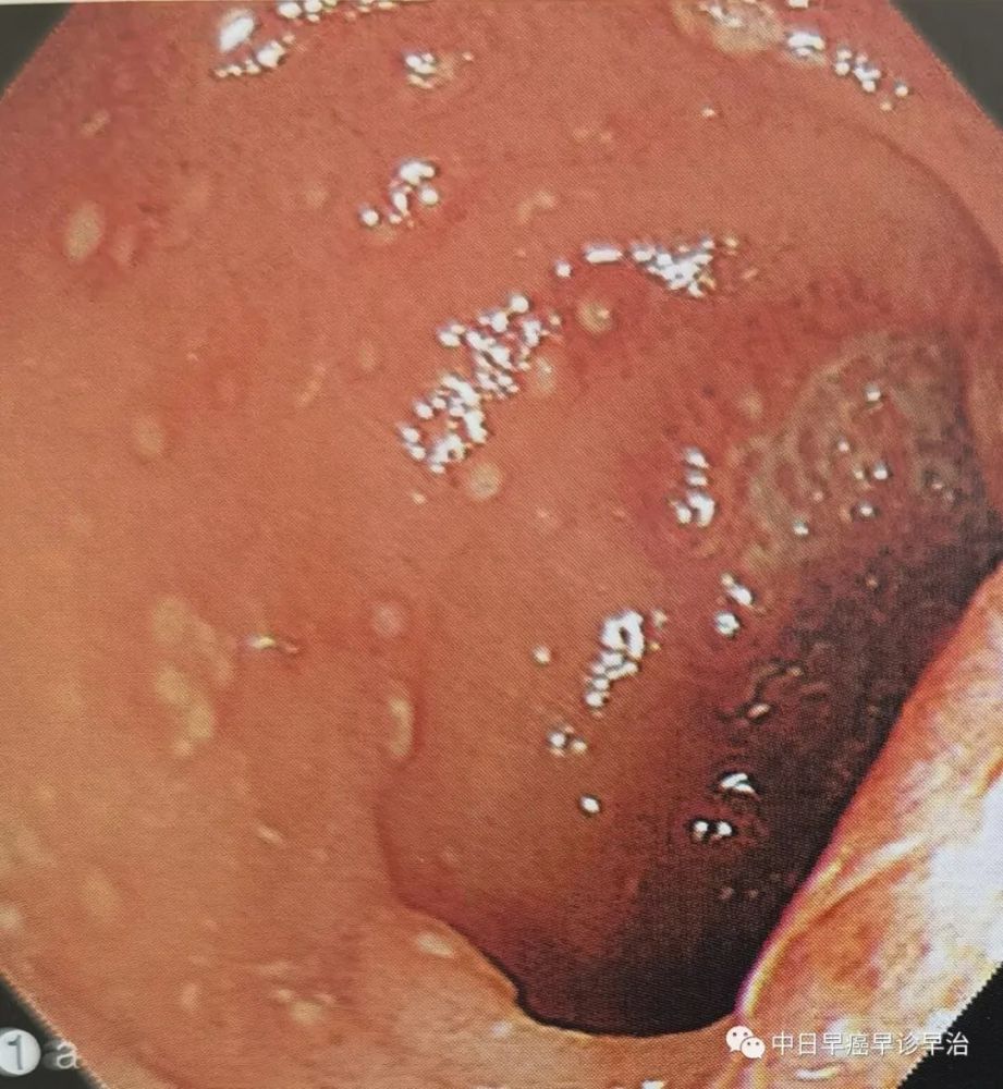 不同病因導致的結腸各種糜爛的口瘡樣結腸炎的鑑別診斷