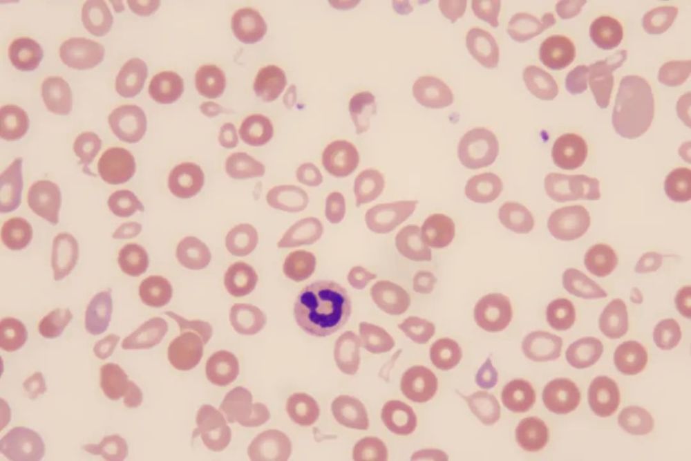 万万没想到血小板假性正常竟然是因为它