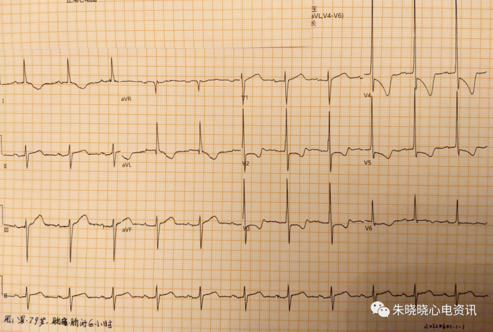 以下壁st段抬高及前壁重度st壓低伴t波倒置的急性心肌梗死_騰訊信聞