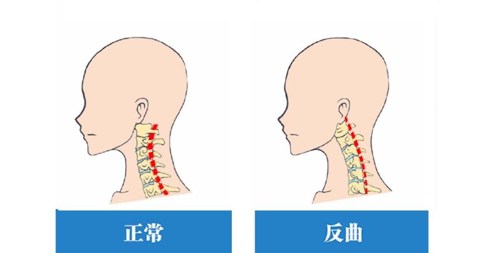 正常人体颈椎示意图图片