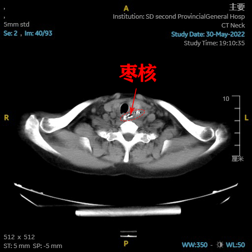 山東省耳鼻喉醫院咽喉科主任崔鵬為趙先生安排了ct檢查,結果顯示,棗核