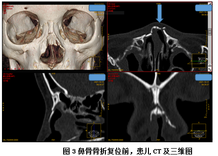 上颌骨鼻前棘骨折图片