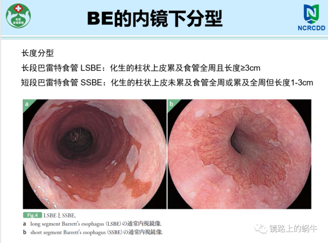 表浅巴雷特食管癌的内镜诊断