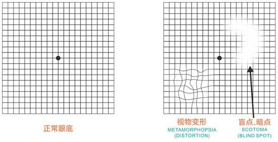 最后,附上一张阿姆斯勒方格表,左右眼分别试一试自己的黄斑是否健康吧