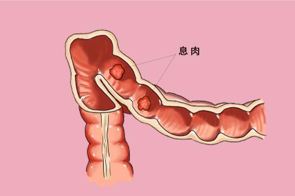 温州医博肛肠医院科普:直肠息肉需要手术吗 什么时候需要手术治疗?