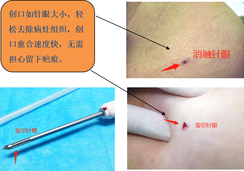 不開刀,術後無疤痕;2.以針代刀,不損傷相鄰器官.