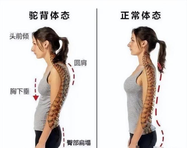 驼背:指胸椎严重向后背隆起,躯干前倾,比圆肩的危害性更大.