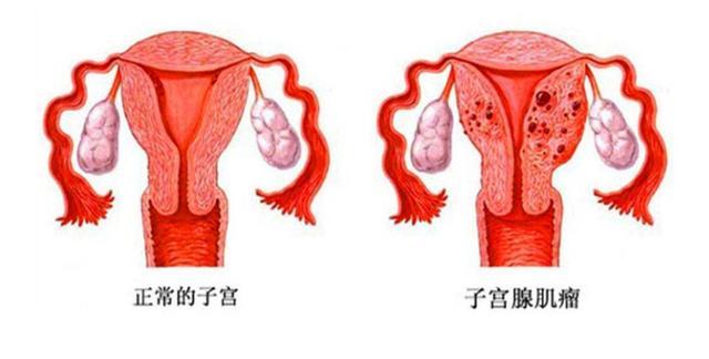 为什么女性特别容易长子宫肌瘤建议平时尽量避免4个行为别大意