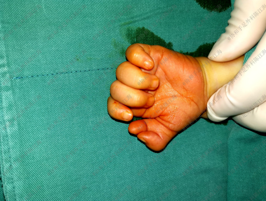 3岁男童天生六指拇指形似蟹钳经手术后成功矫正