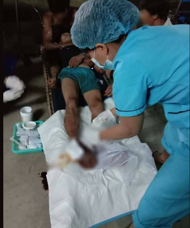 缅甸一男子上山找竹笋,误踩地雷被炸伤,右脚被迫截肢