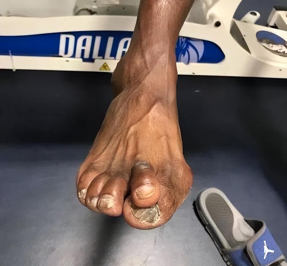 他那超人般的身体素质,19年生涯几乎没有遭遇过重大伤病,即便是崴脚了