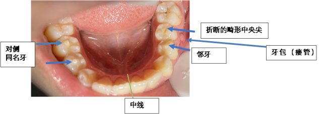 畸形中央尖知多少?|畸形|牙齿