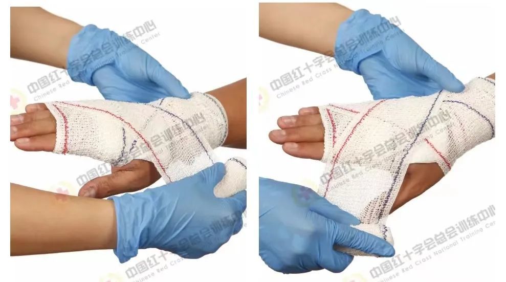 救在身边现场包扎技术之绷带8字包扎