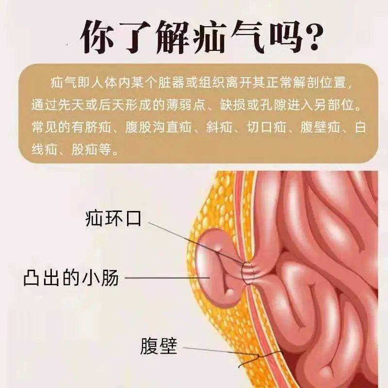 天天健康重視老年疝病患者的治療