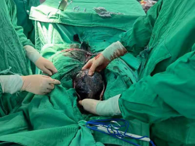 uerterus)胎盘早剥内出血急剧增加,血液积聚于胎盘与子宫壁之间,胎盘