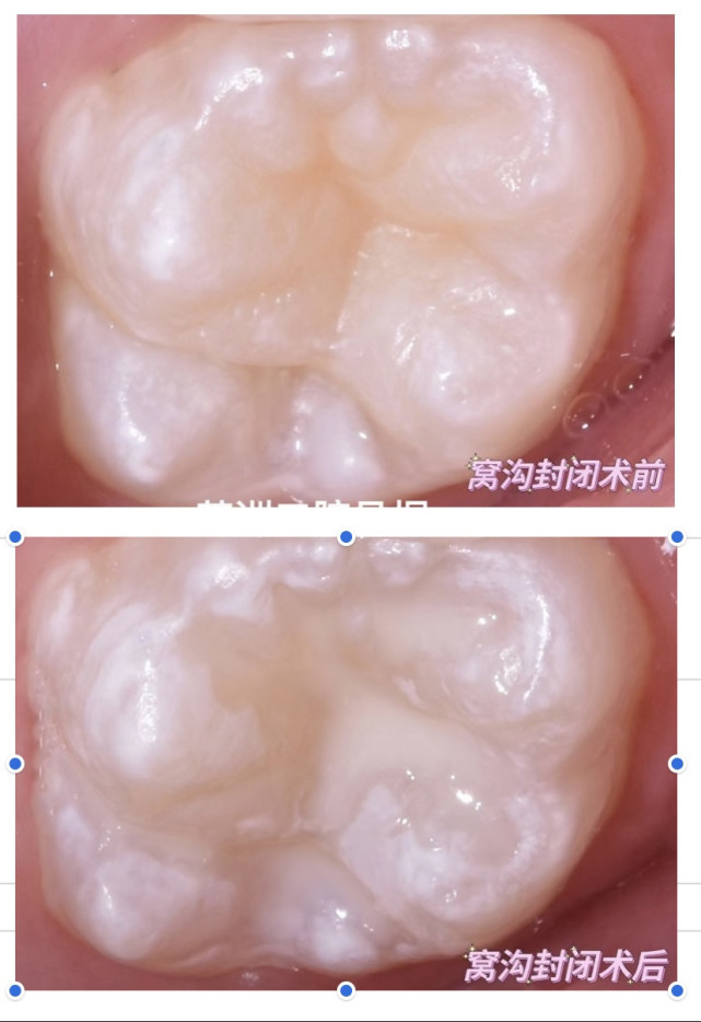 小朋友配合的情況,3-5歲應該做乳磨牙窩溝封閉.