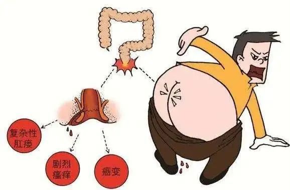 甘肅東大肛腸醫院肛瘻到底需不需要做手術