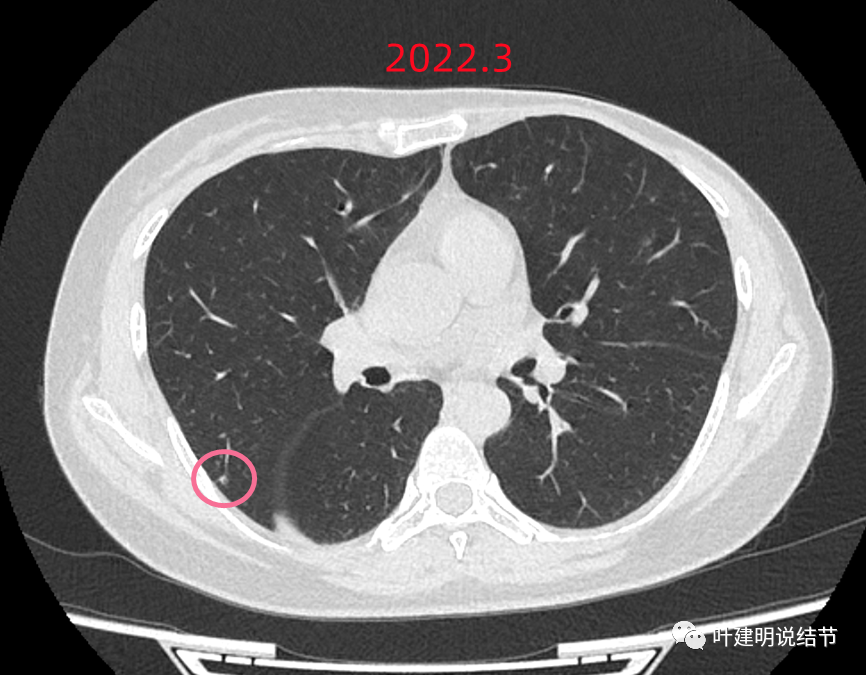 問診分析2022610這個當地6位醫生都考慮是肺癌的結節我為什麼堅持認為