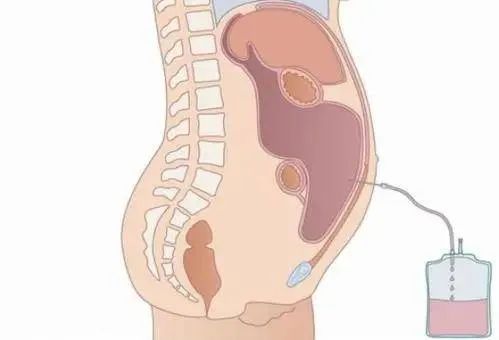 经历了半年的寻医问诊,王先生在河南省肿瘤医院胸腹水门诊得到了有效
