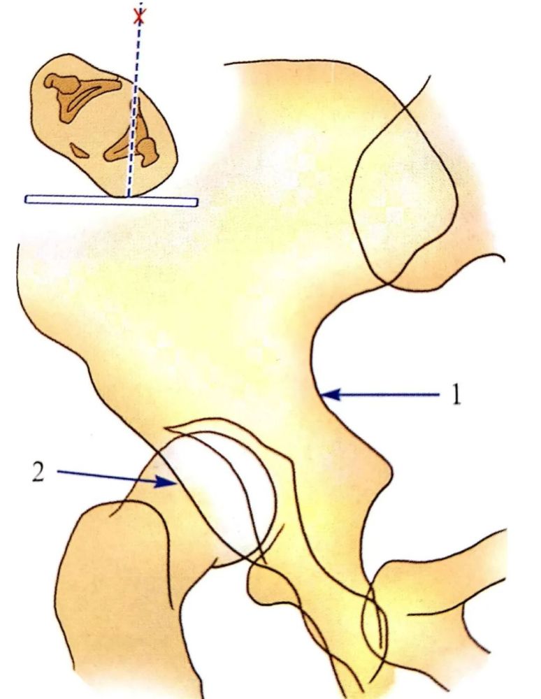 闭孔斜位:患者平卧,身体向健侧倾斜45,显示耻骨联合至髂前下棘及