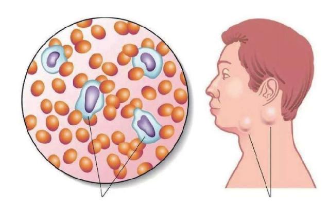 淋巴癌的早期症狀有哪些,最佳治療方法是什麼?