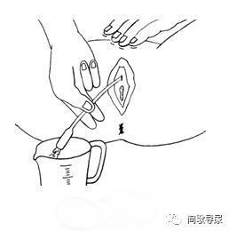 (4)女性患者直接将导管插入尿道,深度在4~6cm左右,直至尿液排出;男性