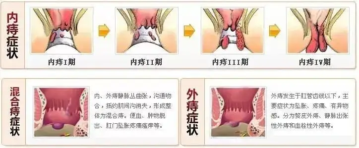 痔疮外痔肉球怎样消除?"痔疮"那些不可描述的秘密,这里告诉你!