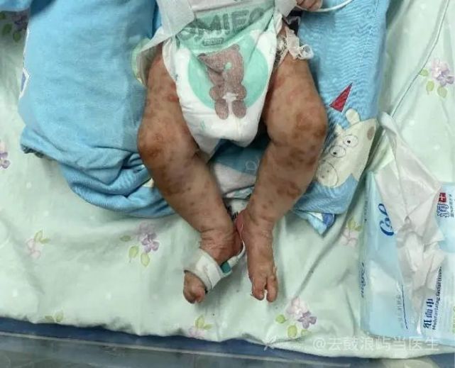 后患儿父母梅毒结果提示 tr