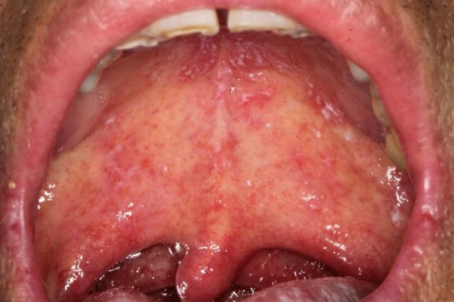 其中口腔念珠菌感染是艾滋病最常见的口腔病损,患病率为4.9%～83.