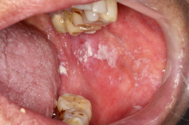 其中口腔念珠菌感染是艾滋病最常见的口腔病损,患病率为49%～83