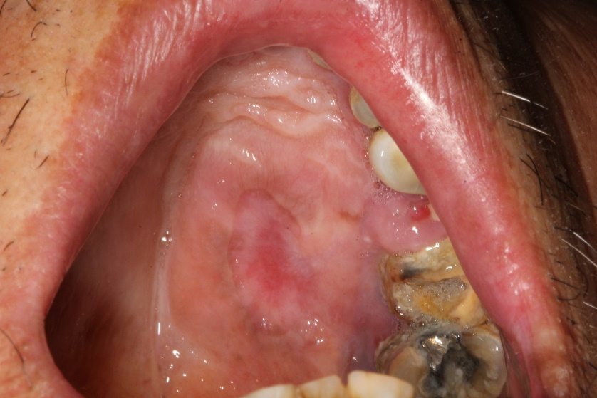 【口腔医学会专栏】艾滋病口腔黏膜病损及治疗_腾讯新闻