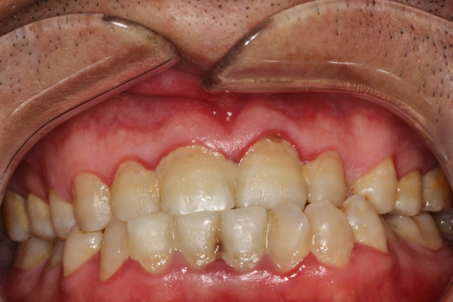 包括牙龈线性红斑,hiv相关性牙周炎,急性坏死性溃疡性牙龈炎和坏死性