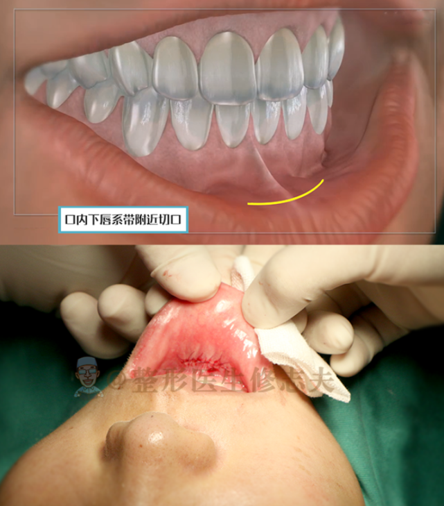 一個是在下巴下方的外切口,一個是在口內下唇繫帶附近的內切口