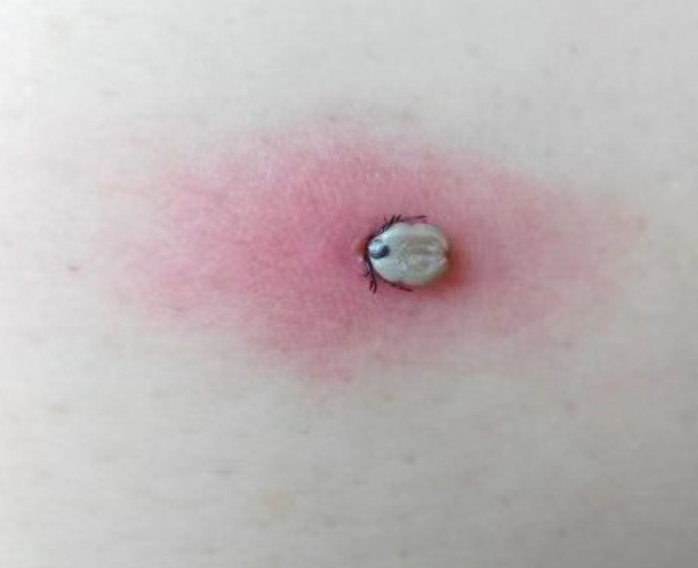 9岁女儿头上被虫钻进头皮吸血1个月妈妈还以为是颗痣