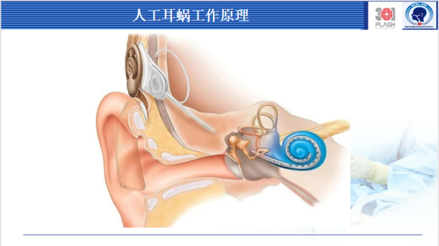 首先洪老師為我們講解了人工耳蝸工作原理.