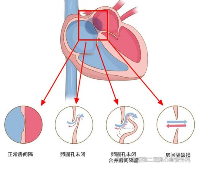 引起青年人不明原因头痛,脑梗,需警惕的心脏卵圆孔未闭演示图.