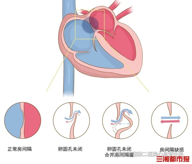 房间隔发育过程图片图片