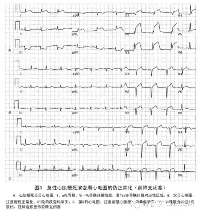 容易忽略的急性心肌梗死心電圖