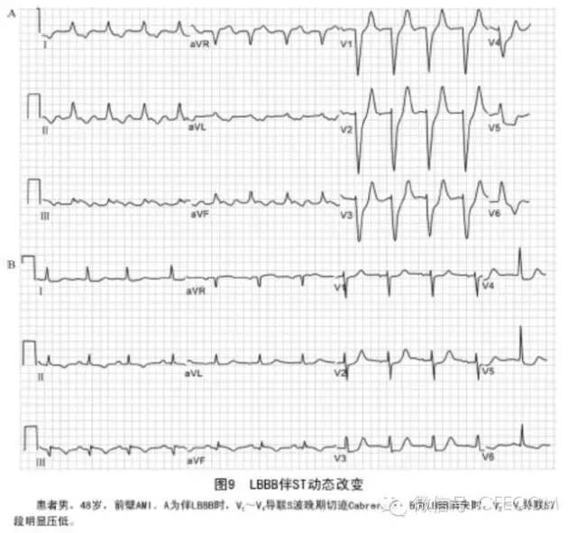 1.4 v1～v4导联r波振幅递减或呈qs波或r波递增顺序改变.6.