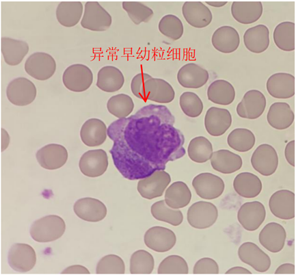 如何識別白細胞散點圖中暗藏的殺機