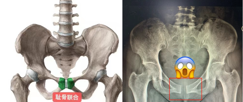 孕产中有一种痛叫"耻骨联合分离"_腾讯新闻