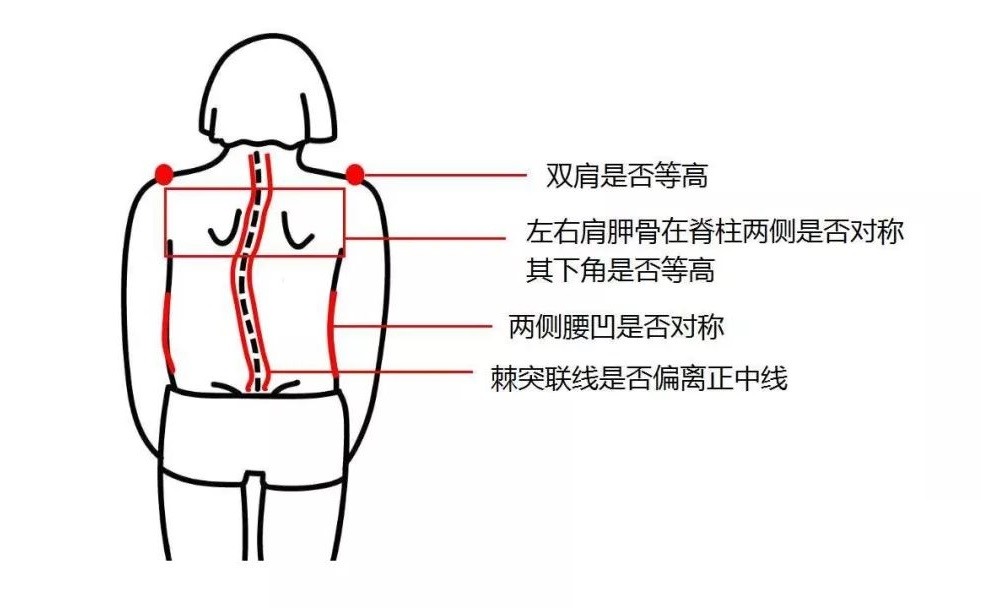 孩子是否有脊柱侧弯教家长几个方法在家可自测