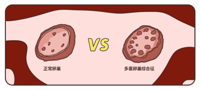 診斷小秦為多囊卵巢綜合徵,多次予以達英35調經以及來曲唑促排治療